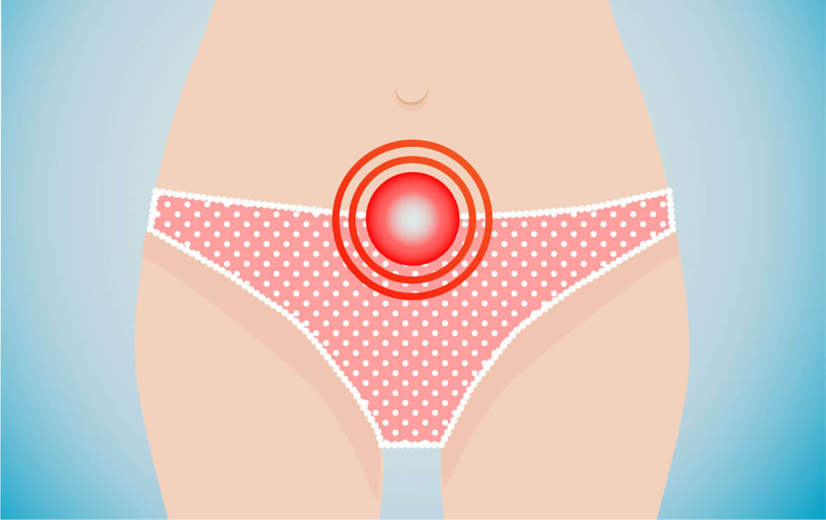 Blasenentzündung bei Frauen